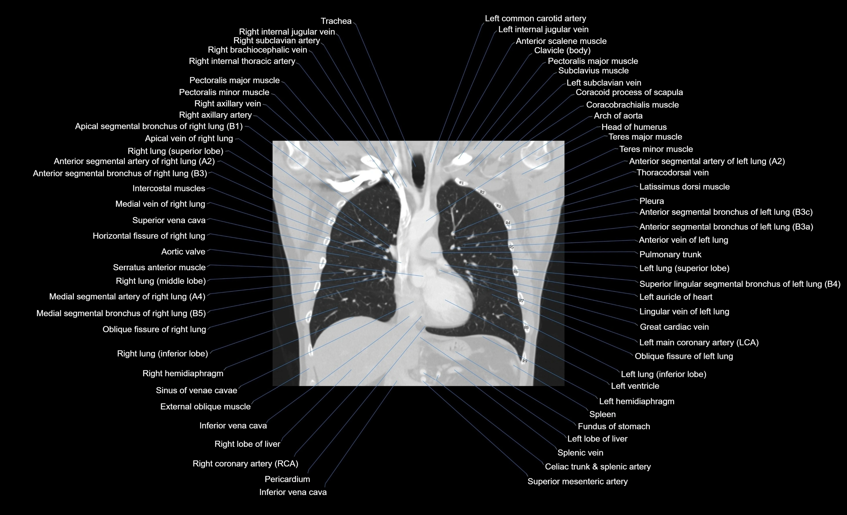 CT chest (thorax) lung window window labelled coronal cross sectional anatomy radiology image-00068.webp